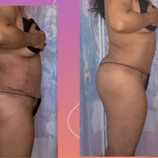 PROMO 8- BODY SCULPTING at Infinity Beauty BlancaG in Denton, TX